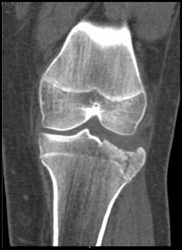 Tibial Plateau- Fracture - CTisus CT Scan