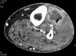 Abscess - CTisus CT Scan