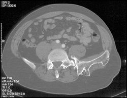 Multiple Exostosis - CTisus CT Scan