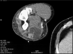 Abscess - CTisus CT Scan