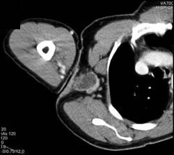 Necrotic Nodes With Cat Scratch Fever - CTisus CT Scan