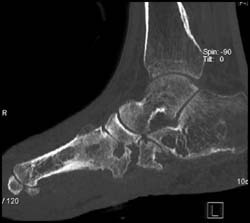 Gout - CTisus CT Scan