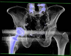 Total Hip Replacement (THR) in 3D/MPR - CTisus CT Scan