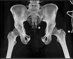 Trauma With Widening of Symphysis of Left SI Joint - CTisus CT Scan