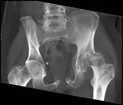 Degenerative Joint Disease (DJD) With Joint Effusions - CTisus CT Scan