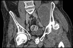 Fluid Collection in Iliopsoas - CTisus CT Scan