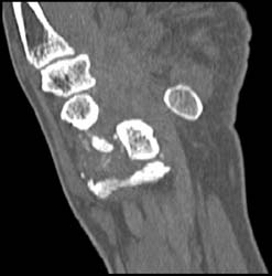 Osteonecrosis - CTisus CT Scan