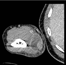 Abscess - CTisus CT Scan