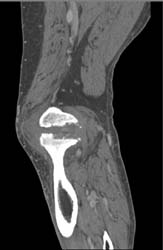 CTA for Popliteal Artery Which Is Normal - CTisus CT Scan