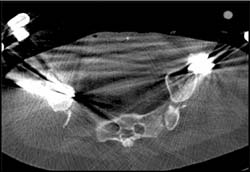 Post Pelvic Reconstruction - CTisus CT Scan