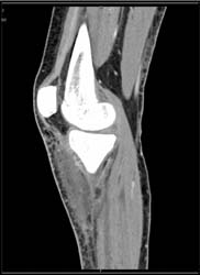 Cellulitis - CTisus CT Scan