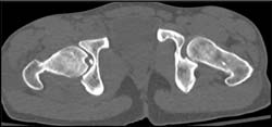 Fragment in Hip Joint - CTisus CT Scan