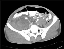 Iliopsoas Bleed - CTisus CT Scan