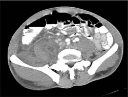 Psoas Abscess - CTisus CT Scan