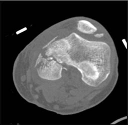 Femur and Patella Fracture - CTisus CT Scan