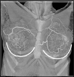 Collaterals in Chest Wall - CTisus CT Scan