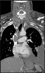 SVC Occlusion With Collaterals - CTisus CT Scan