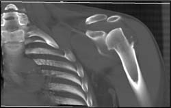 Scapular and Humerus Fractures - CTisus CT Scan