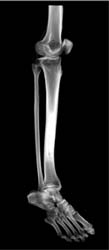 Sclerosis of Tibia - CTisus CT Scan