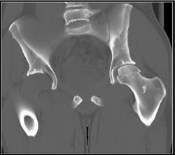 Dislocated Hip With Acetabular Fracture - CTisus CT Scan