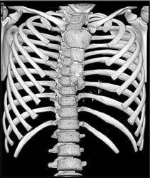 Pectus Deformity - CTisus CT Scan