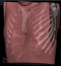 Pectus Deformity - CTisus CT Scan