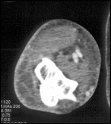 Abscess - CTisus CT Scan