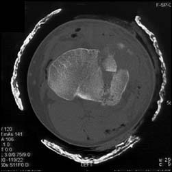 Tibial Plateau Fracture - CTisus CT Scan