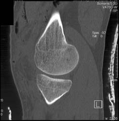 Tibial Plateau Fracture - CTisus CT Scan