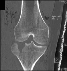 Tibial Plateau Fracture - CTisus CT Scan