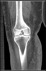 Calcified Menisci - CTisus CT Scan