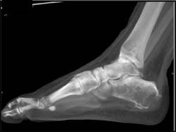 Lung Cancer Metastatic to Calcaneus - CTisus CT Scan