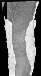 Patent Popliteal Artery - CTisus CT Scan