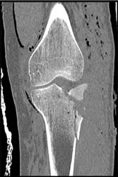 Tibeal Plateau Fracture - CTisus CT Scan