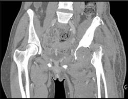 S/P Left Arthroplasty - CTisus CT Scan