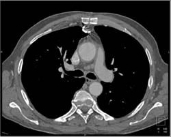 Broken Wire S/P Mediastinal Surgery - CTisus CT Scan