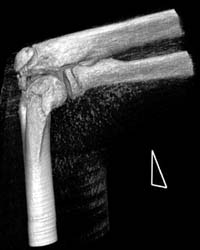 Humerus Fracture - CTisus CT Scan