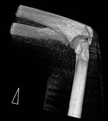 Humerus Fracture - CTisus CT Scan