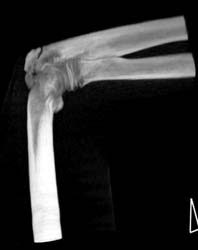 Humerus Fracture - CTisus CT Scan