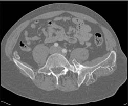 Exostosis - CTisus CT Scan