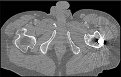 Exostosis - CTisus CT Scan