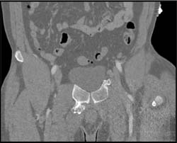 Exostosis - CTisus CT Scan