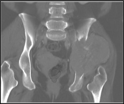 Chondrosarcoma - CTisus CT Scan