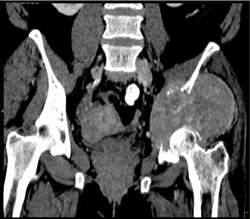 Lung Cancer Metastatic to the Iliac Wing - CTisus CT Scan