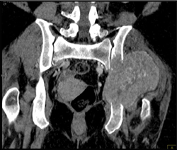 Lung Cancer Metastatic to the Iliac Wing - Musculoskeletal Case Studies ...