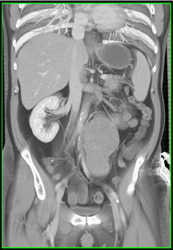 Schwannoma - CTisus CT Scan