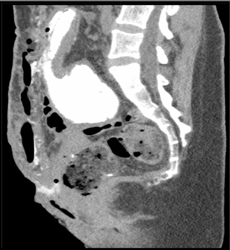 Exstrophy - CTisus CT Scan