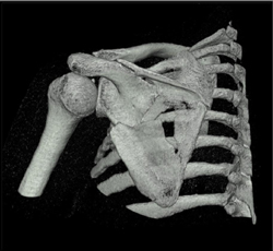 Scapular Fracture - CTisus CT Scan