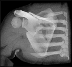 Scapular Fracture - CTisus CT Scan