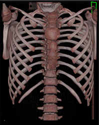 Pectus Deformity - CTisus CT Scan